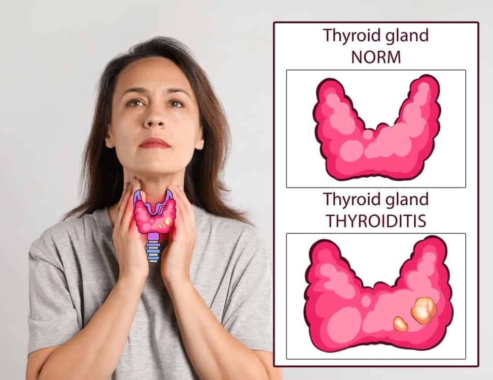 female swollen thyroid
